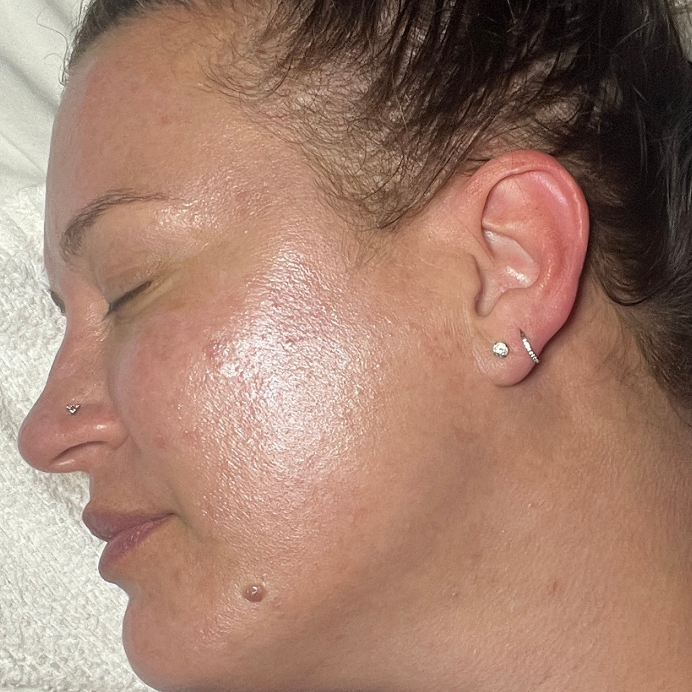 Chemical-Peel-After-Scottsdale-AZ