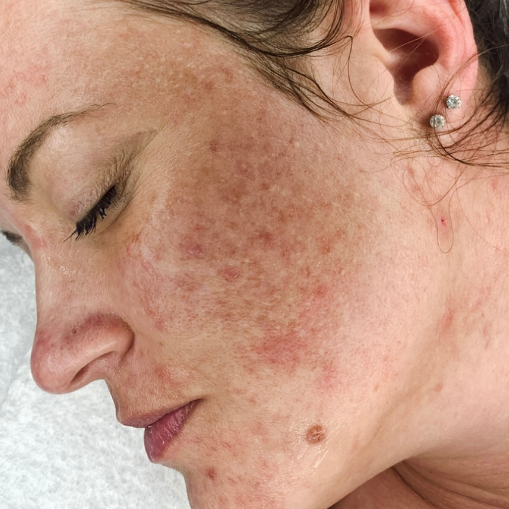 Chemical-Peel-Before-Scottsdale-AZ