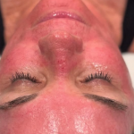 How to Maintain Results from Microneedling, PRP & RF Treatments