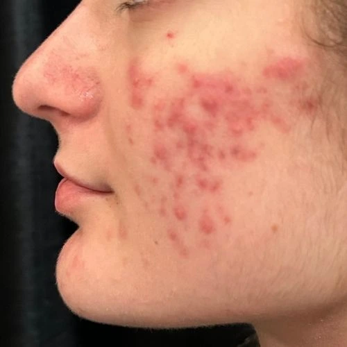 AviClear-Acne-Before-Scottsdale-AZ AviClear Client Before her Treatments.