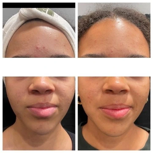 Front View of a15 Year Old Girl Before and After AviClear Treatment