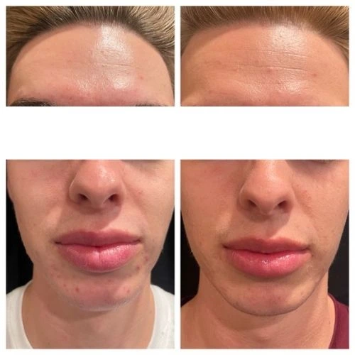 Front View of a 25 Year Old Man Before and After AviClear Treatment