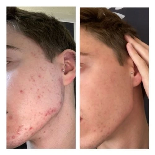 Side View of a 25 Year Old Man Before and After AviClear Treatment