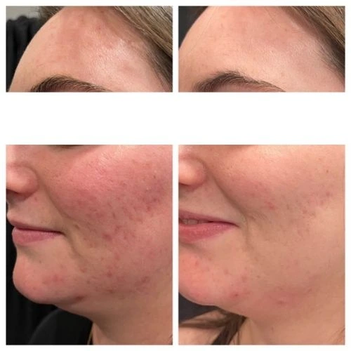 Left Side View of a 20 Year Old Woman Before and After AviClear Treatment