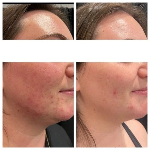 Right Side View of a20 Year Old Woman Before and After AviClear Treatment