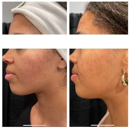 Side View of a15 Year Old Girl Before and After AviClear Treatment