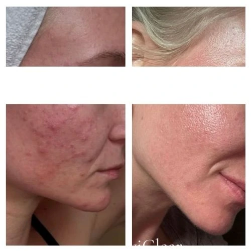 Side view of a 30 Year Old Woman Before and After AviClear Treatment