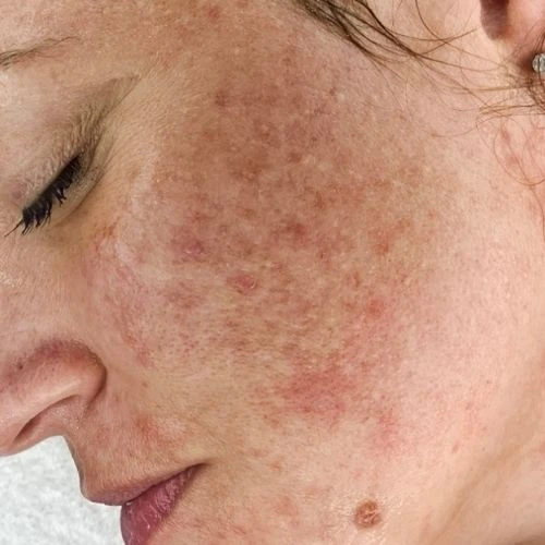 Chemical-Peel-Before-Scottsdale-AZ Woman with a lot of acne scarring and sun damage - Before VI Peel