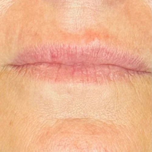 Lip-Filler-Scottsdale-AZ-Before Woman's Thin Lips before Filler Injections
