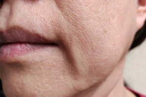 Woman's sagging jowels from weight loss in Scottsdale, AZ