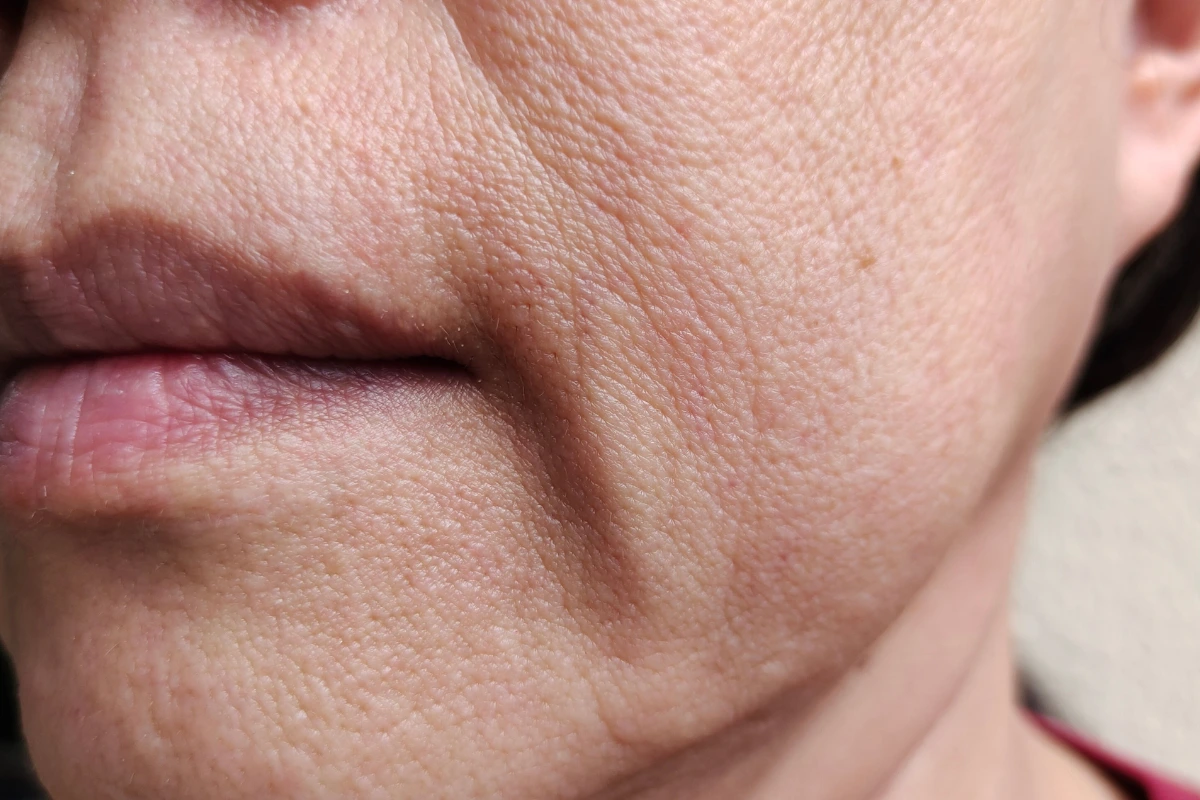 Woman's sagging jowels from weight loss in Scottsdale, AZ