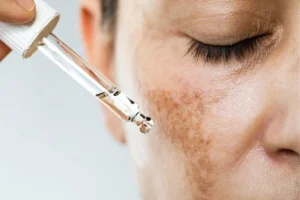 Woman putting serum on her melasma in Scottsdale, AZ.
