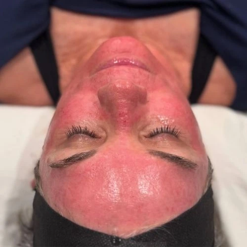 Woman after SkinPen Microneedling Treatment at Collab Medspa