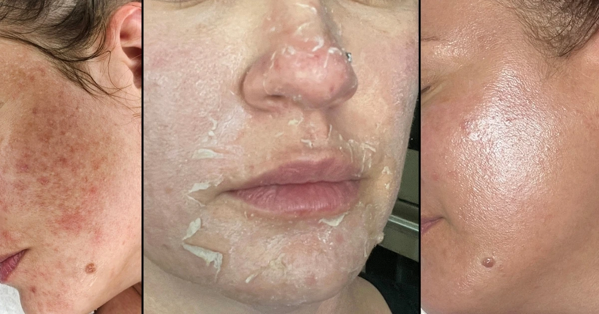 Before, during and after a VI Peel at Collab Medspa