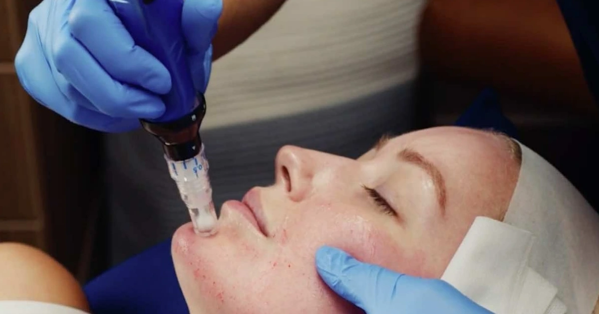 Woman having a SkinPen Microneedling Treatment in Scottsdale, AZ.