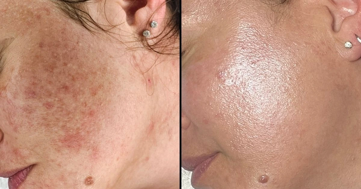 Sun Damage before and after VI Peels at Collab Medspa