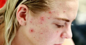 Girl with Acne