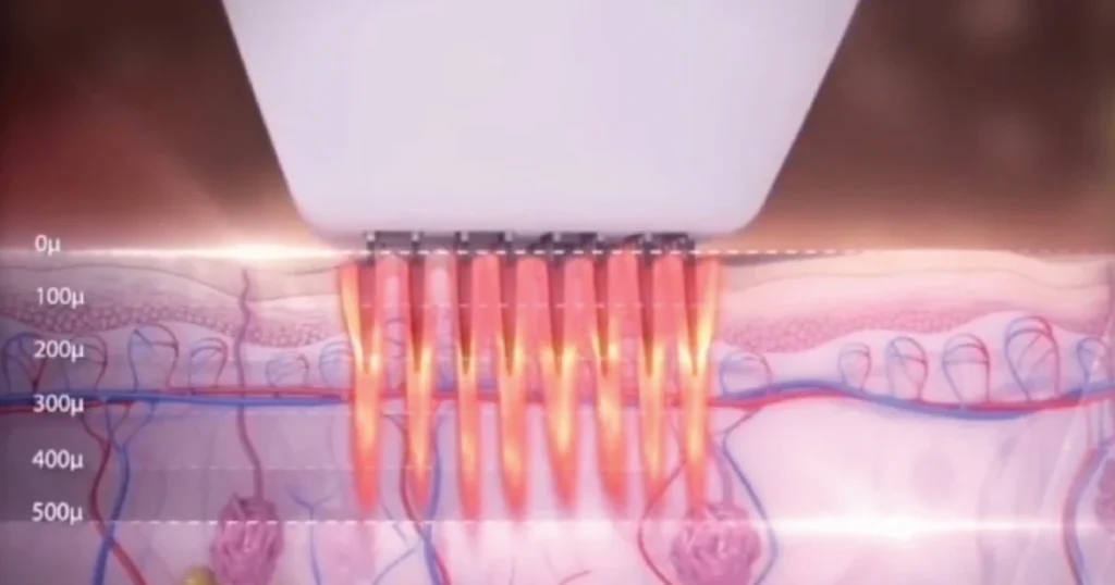 Diagram showing how deep RF Technology delivers energy into skin at Collab Medspa.
