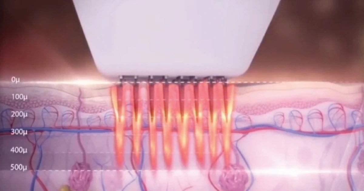 Diagram showing how deep RF Technology delivers energy.