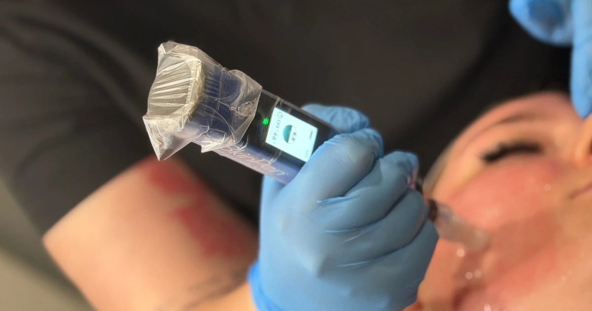 SkinPen Microneedling Treatment at Collab Medspa in Scottsdale, AZ