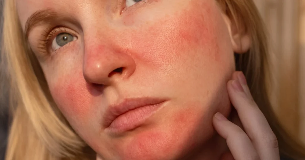 Concerned Woman with Rosacea Skin Flare Up
