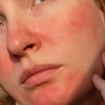 Are Facials Safe for Rosacea? What to Know Before You Book