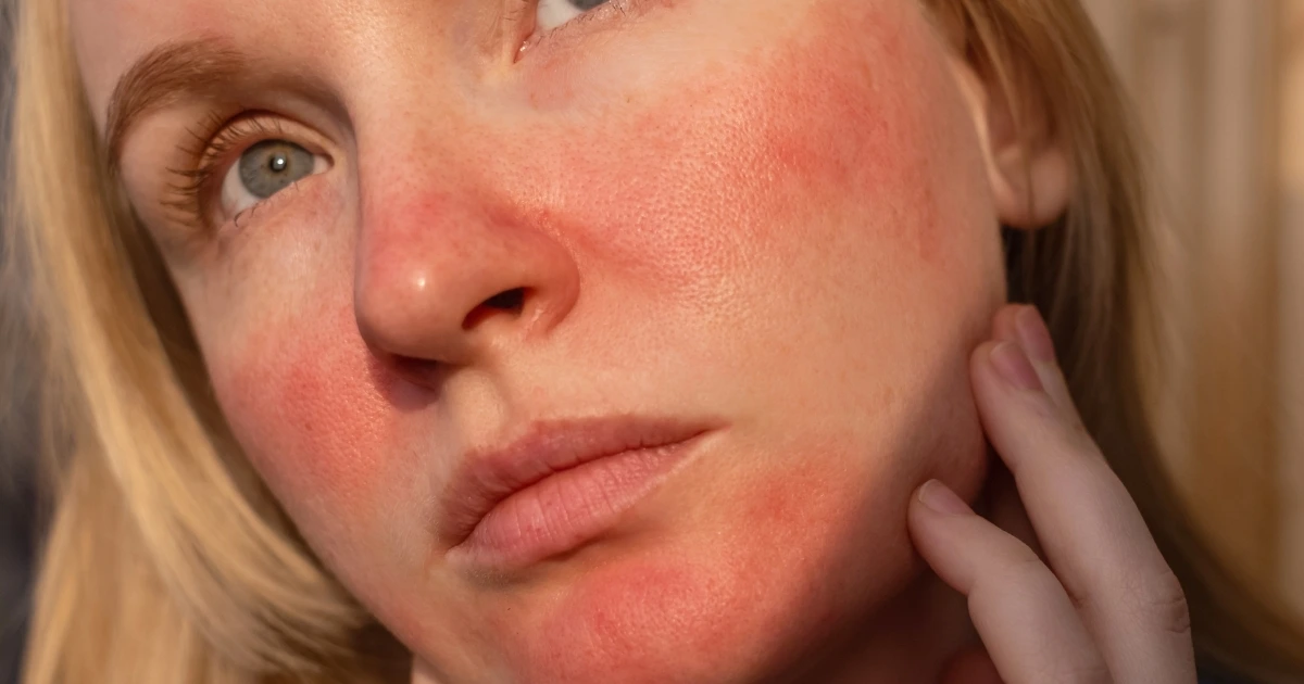 Concerned Woman with Rosacea Skin Flare Up