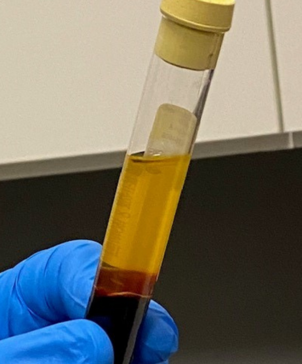 PRP-Microneedling-Scottsdale-AZ